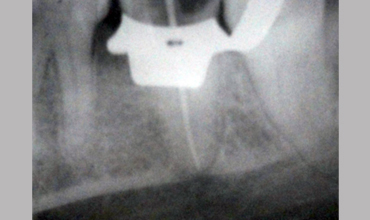 Teeth whitening in Anand
                        